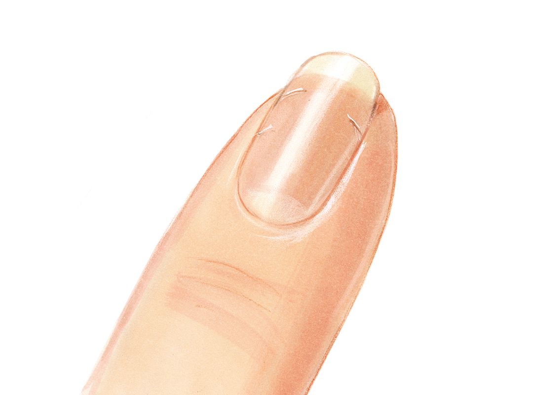 Jessica Nails Analysis Brittle